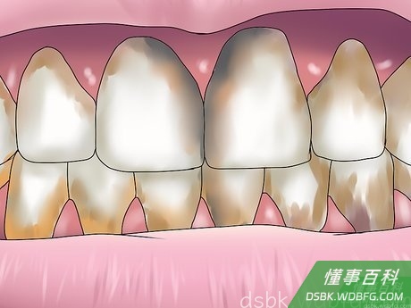 Step 2 严重的牙龈疾病是牙骨质流失的主要原因。