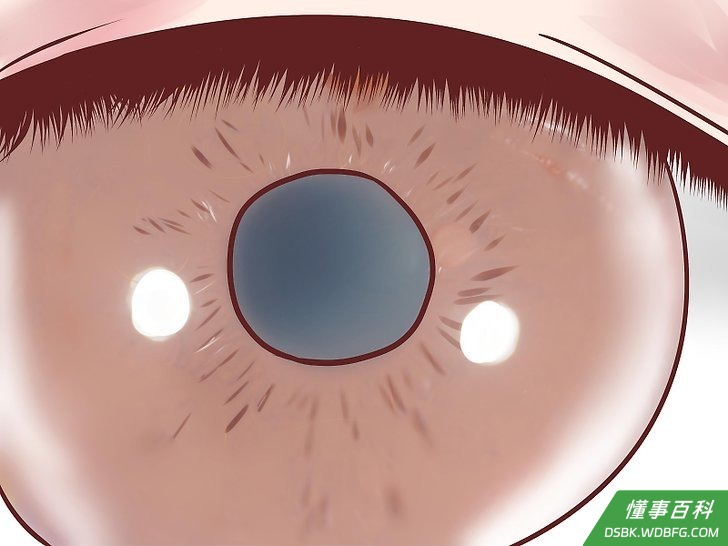 Step 2 弄清楚导致高眼压的原因。