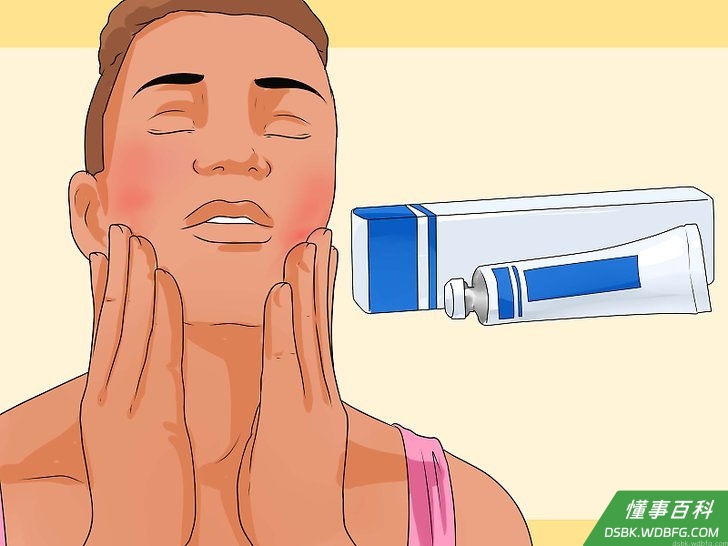 Step 1 使用外用类固醇软膏。