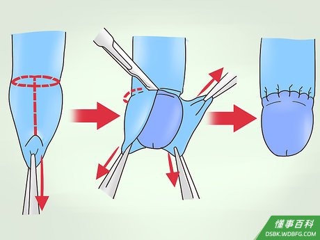 Step 3 考虑做包皮手术。