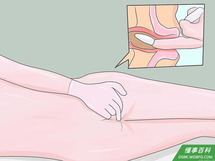 Step 3 把经过润滑的栓剂顶端塞入肛门。