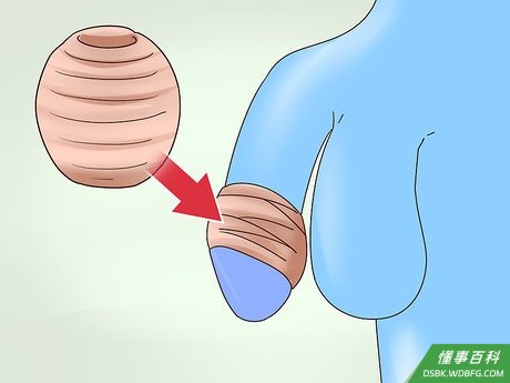 Step 6 使用包皮阻复环。