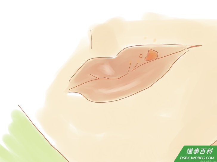 Step 14 治疗唇疱疹。