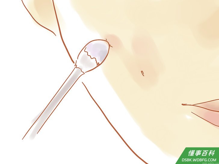 Step 2 治疗痤疮。