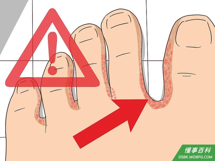 Step 1 识别脚气。