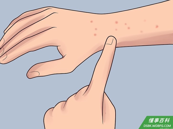 Step 5 在人体身上检查疥螨的迹象。