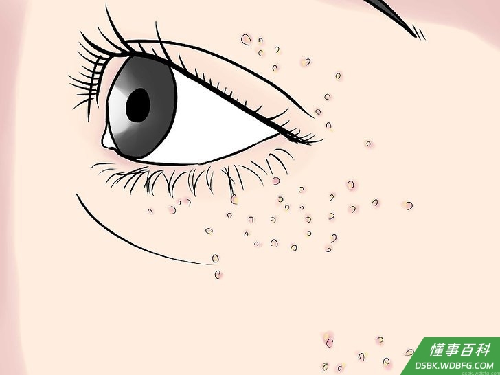 Step 4 在嘴唇、嘴巴、眼睛、舌头和身体其它部位寻找水疱。